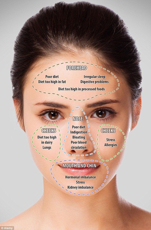 Doctor of traditional Chinese medicine and wellbeing expert, John Tsagaris, believes that breakouts on varioys areas of the face can reflect different problems in your internal health Doterra Acne, Gesicht Mapping, Acne Chart, Face Mapping Acne, Face Mapping, Face Acne, Acne Remedies, Acne Skin, Chinese Medicine