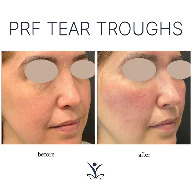 Platelet-rich fibrin (PRF) is a natural, regenerative solution for tear troughs/under eye hollows! 🙌 We derive the PRF from a small sample of your blood to get a concentrated serum of growth factors. We then inject the PRF in areas that need more volume, like the tear troughs. Over the next six weeks the growth factors will stimulate the development of new collagen, elastin and fibrin. . . . teartroughs #darkcircles #rejuvenationmd Eye Hollows, Under Eye Hollows, Platelet Rich Plasma Therapy, Tear Trough, Skin Care Pictures, Platelet Rich Plasma, Cool Sculpting, Breast Lift, Botox Fillers