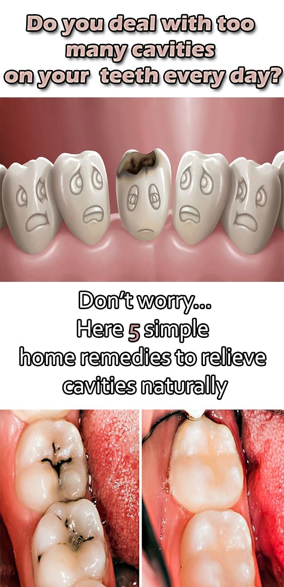 Eating too much sugar or not paying enough attention to teeth cleaning can cause tooth decay and tooth cavity. Due to worms in the teeth, that tooth gradually ends. But by adopting some home remedies, cavities can get rid of naturally. Cavity Remedy, Reverse Cavities, Tooth Cavity, Tooth Decay Remedies, Heal Cavities, Teeth Health, Oral Care Routine, Gum Care, Receding Gums