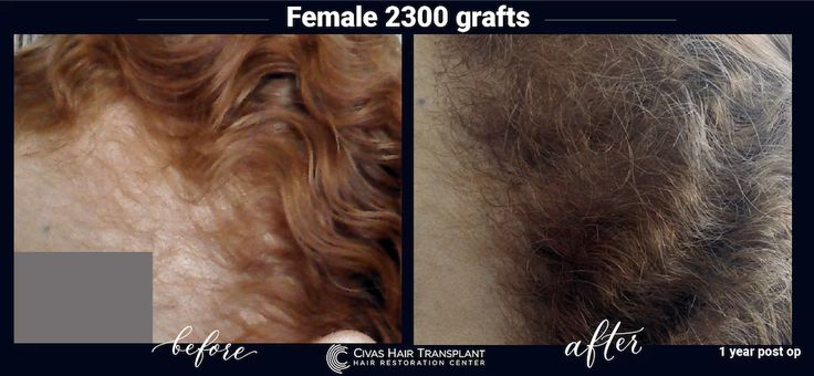 Hair Transplant Photos | Civas Hair Transplant Hair Transplant Women, Eyebrow Transplant, Female Hair, Hair Restoration, Hair Transplant, Mens Hairstyles, Eyebrows, Womens Hairstyles, Hair