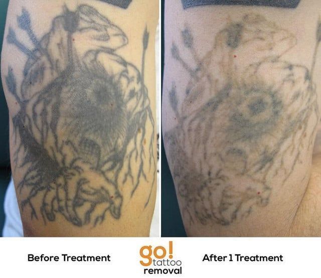 before and after photos of a tattoo removal