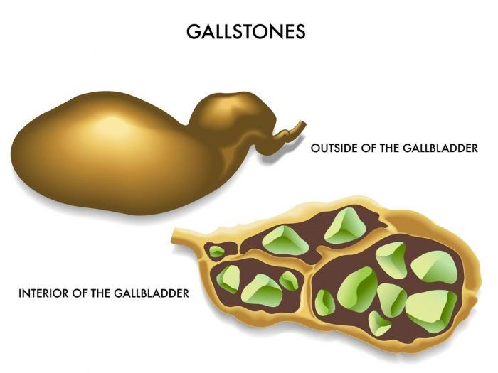 Those who are experiencing severe pain in the upper abdominal region and also in the shoulder blades for long and sometimes short period should get themselves checked up for gall stones. There are quite a number of home remedies which can help you get rid of the trouble of gall stones. Consuming coffee on a regular basis will stop gall stones before they can form inside the gall bladder. Avoiding the unhealthy junk foods can help preventing this problem. Regular exercise regime supported with... Gallbladder Cleanse, Gallbladder Stones, Gallbladder Diet, Mthfr Gene Mutation, Mthfr Gene, Gut Problems, Gall Bladder, Low Stomach Acid, Natural Treatments