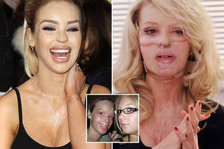 KATIE PIPER has charmed the UK with her heroic story of overcoming a horrific acid attack to become a household name as a TV presenter. Now, her inspirational life story is set to hit the silver sc… Jealous Ex, Acid Attack, Katie Piper, Tv Presenter, Modern Muse, Life Story, Ex Boyfriend, Role Models, Hollywood