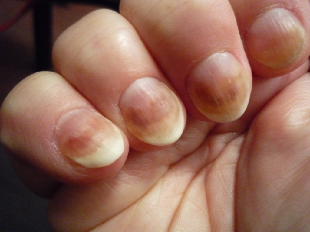 15 Health WARNINGS Your Fingernails Are Sending