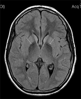 Iron deposition in globus pallidus.jpg