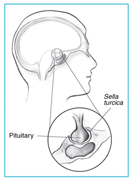 Prolactinoma-art.jpg