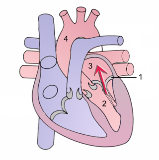 Mitral Regurgitation scheme1.png