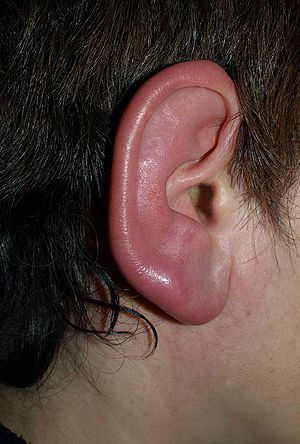 Redness and swelling of an ear