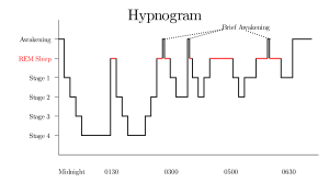 Hypnogram showing sleep cycles from midnight to morning.