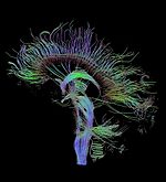 An image of neural pathways in the brain taken using diffusion tensor imaging