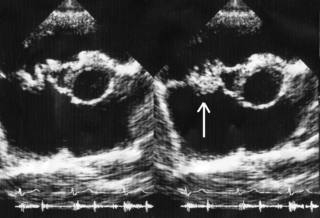 Endocarditis ultrasound.gif