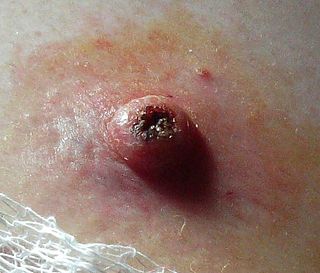 Keratoacanthoma 2.jpg