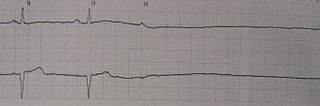 Asystole11.JPG