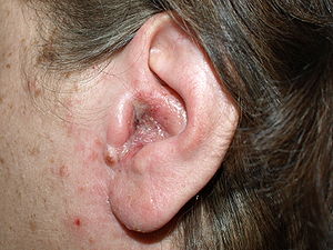 Exudate over a background of redness on the external ear canal of an adult