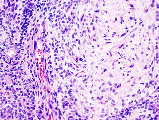 Pleomorphic adenoma (1) parotid gland.jpg