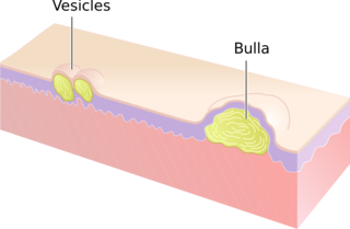 Vesicles and Bulla.svg