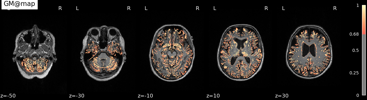 nipype-preprocess-on-brain-MR