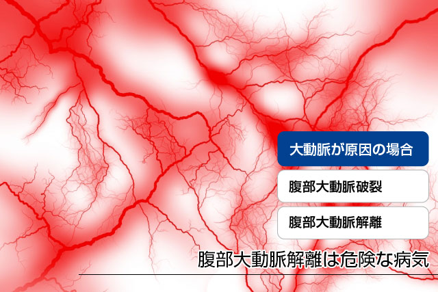 腹部大動脈解離は危険な病気