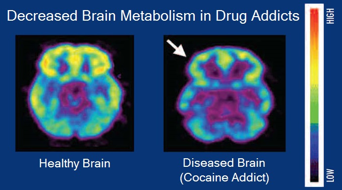 File:Brain metabolism and drug addiction.jpg