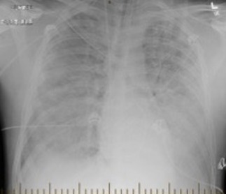 File:Radiographic progression of hantavirus pulmonary syndrome in patient (cropped a).jpg