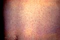 Rash on the abdomen caused by German measles (rubella).