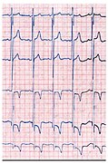 May 14: ECG of a patient with Fabry's disease.