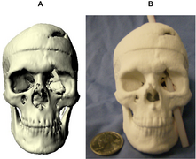 June 26: This model of Phineas Gage's skull illustrates the approximate path of the tamping iron that produced his famous injury.