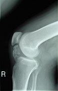 July 25: Lateral radiograph of the knee demonstrating ossification in the peritendinous tissues in a patient with osteochondroma.