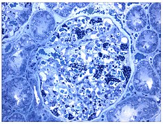 June 29: Kidney biopsy (light microscopy) in which the purple stain is on the podocytes.