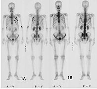 April 9: Bone scintigraphy of a patient with colorectal cancer before and after chemotherapy.