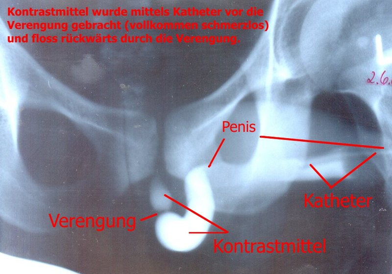 File:Urethra stricture.jpg