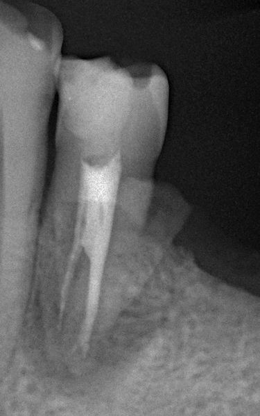 File:Fractured tooth rx.jpg