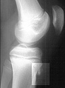 May 29: Lateral X-ray image of a human knee, with fragmentation of the tibial tubercle.