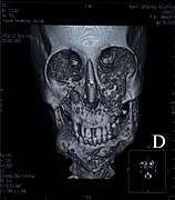 April 18: Computed tomography of a patient with Cherubism, showing bone malformation in both the mandible and the maxilla.