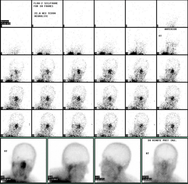 File:Radionuclide Cerebral Blood Flow Scan.png