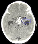 April 27: CT scan of a craniopharyngioma.