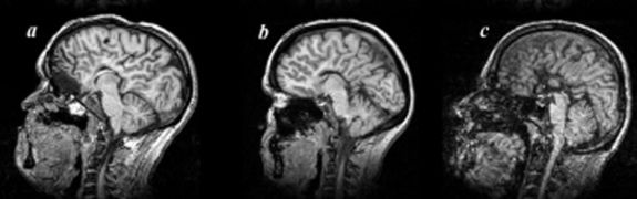 March 16: MRI scans of patients lacking a corpus callosum.