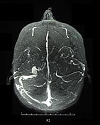 November 2: Venogram showing cerebral venous sinus thrombosis in a patient with Behçet's disease