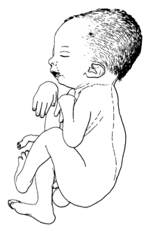 Arthrogryposis multiplex congenita (by Adolph Wilhelm Otto 1841).png