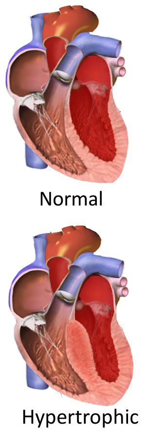 Hypertrophic obstructive cardiomyopathy.png