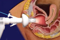 Dilating vaginal speculum inflating vagina and light illuminating.jpg