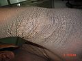 Familial acanthosis nigricans4.jpg