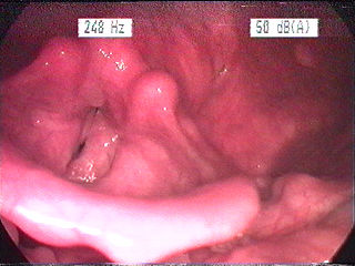 Laryngitis gastrica.jpg