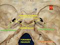 Inner surface of the sphenoid bone, showing the foramen spinosum