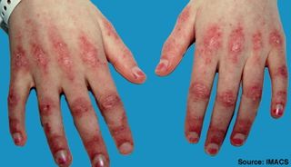 Dermatomyositis2.jpg