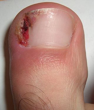 Ingrown nail 002.jpg