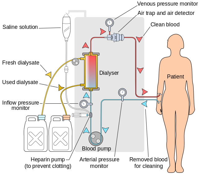 Hemodialysis-en.svg