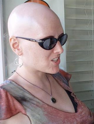 AlopeciaTotalis.jpg