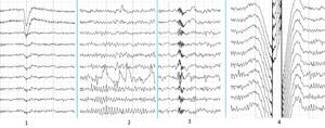  Main types of artifacts in human EEG