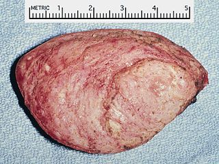 Cardiac rhabdomyoma.jpg